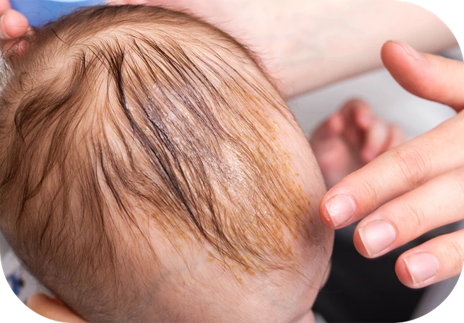 prevenir y tratar la costra láctea prevenir y tratar la costra láctea en bebés