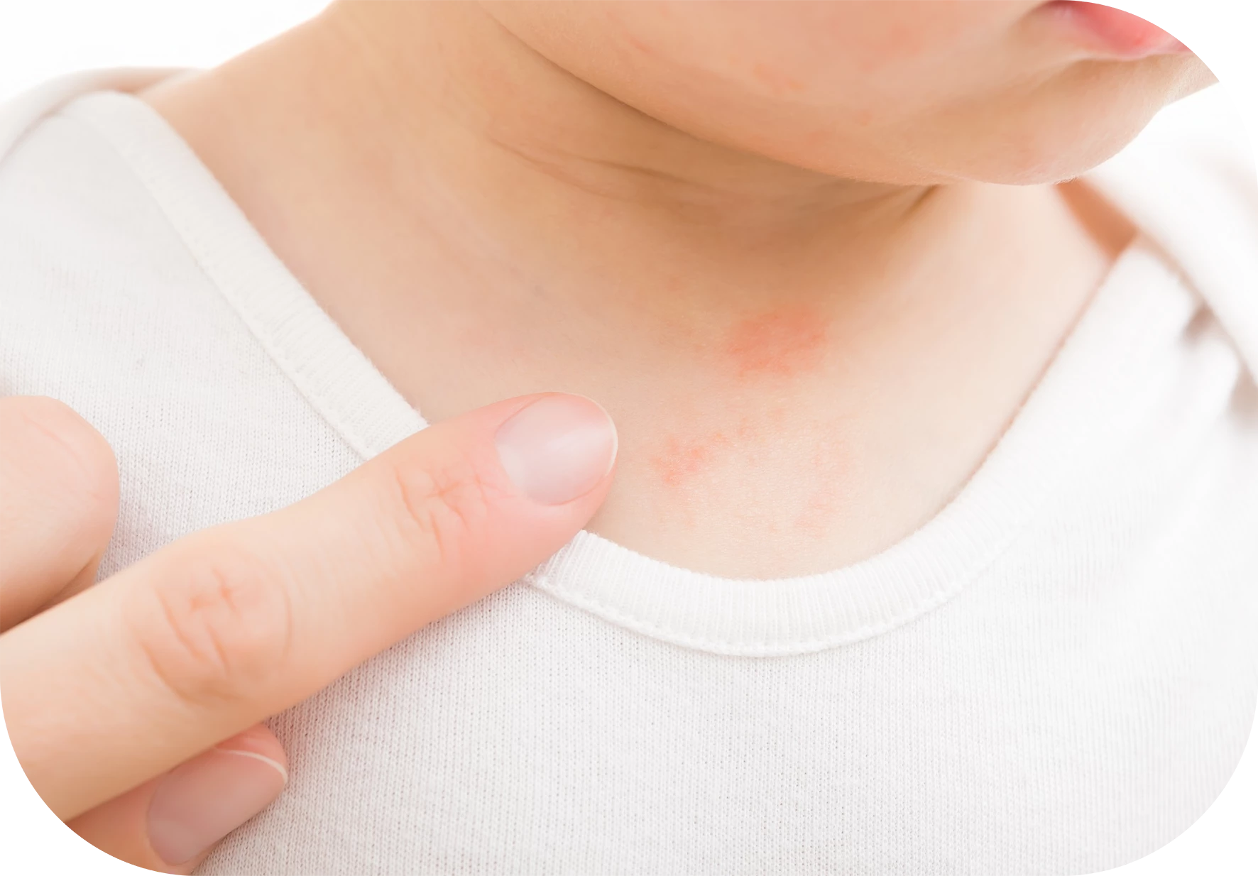 irritación en el cuello del bebé