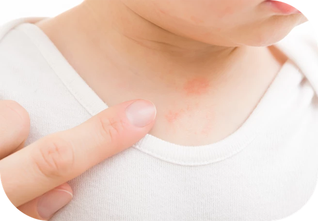 Irritaciones frecuentes en el cuello del bebe Irritaciones frecuentes en el cuello del bebe