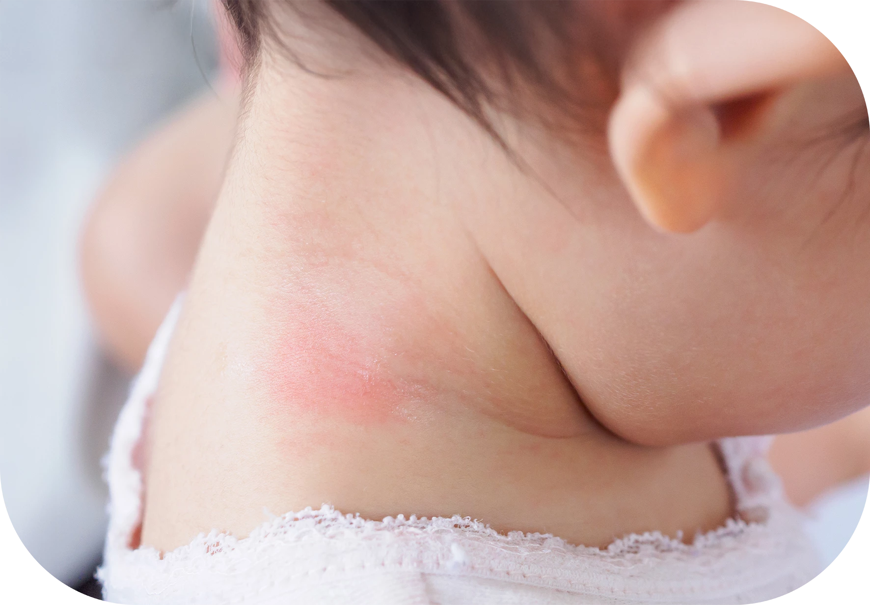 irritación en el cuello del bebé