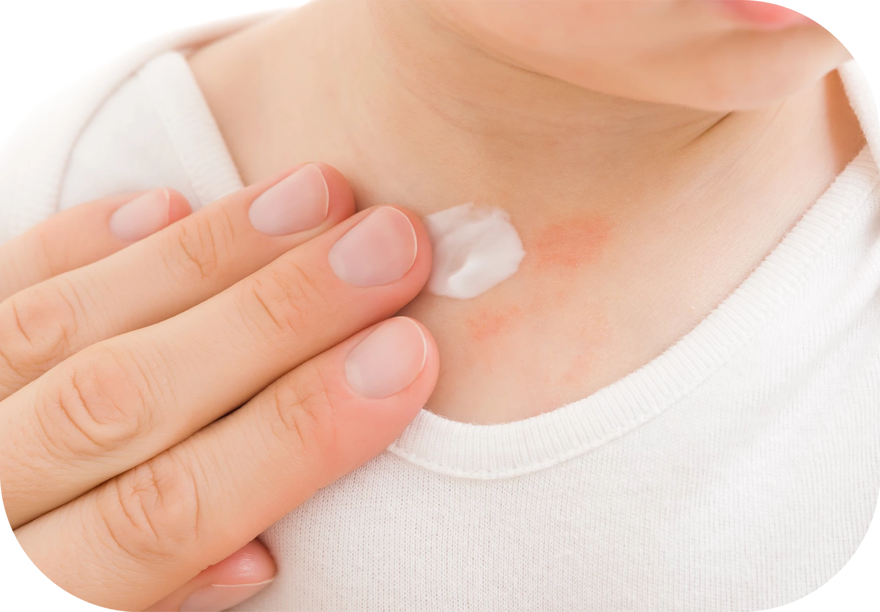 Irritaciones frecuentes en el cuello del bebé