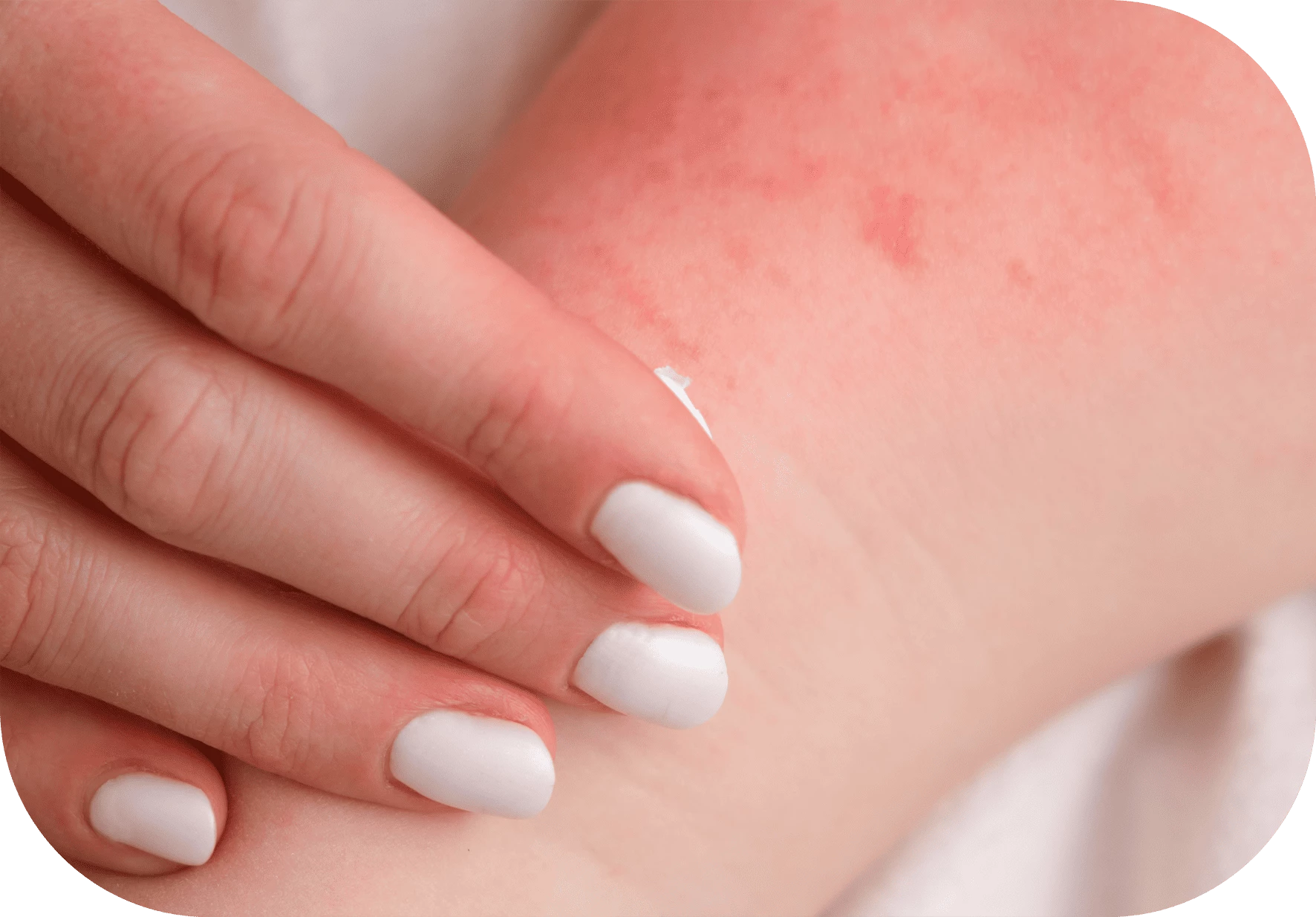 irritación piel bebé