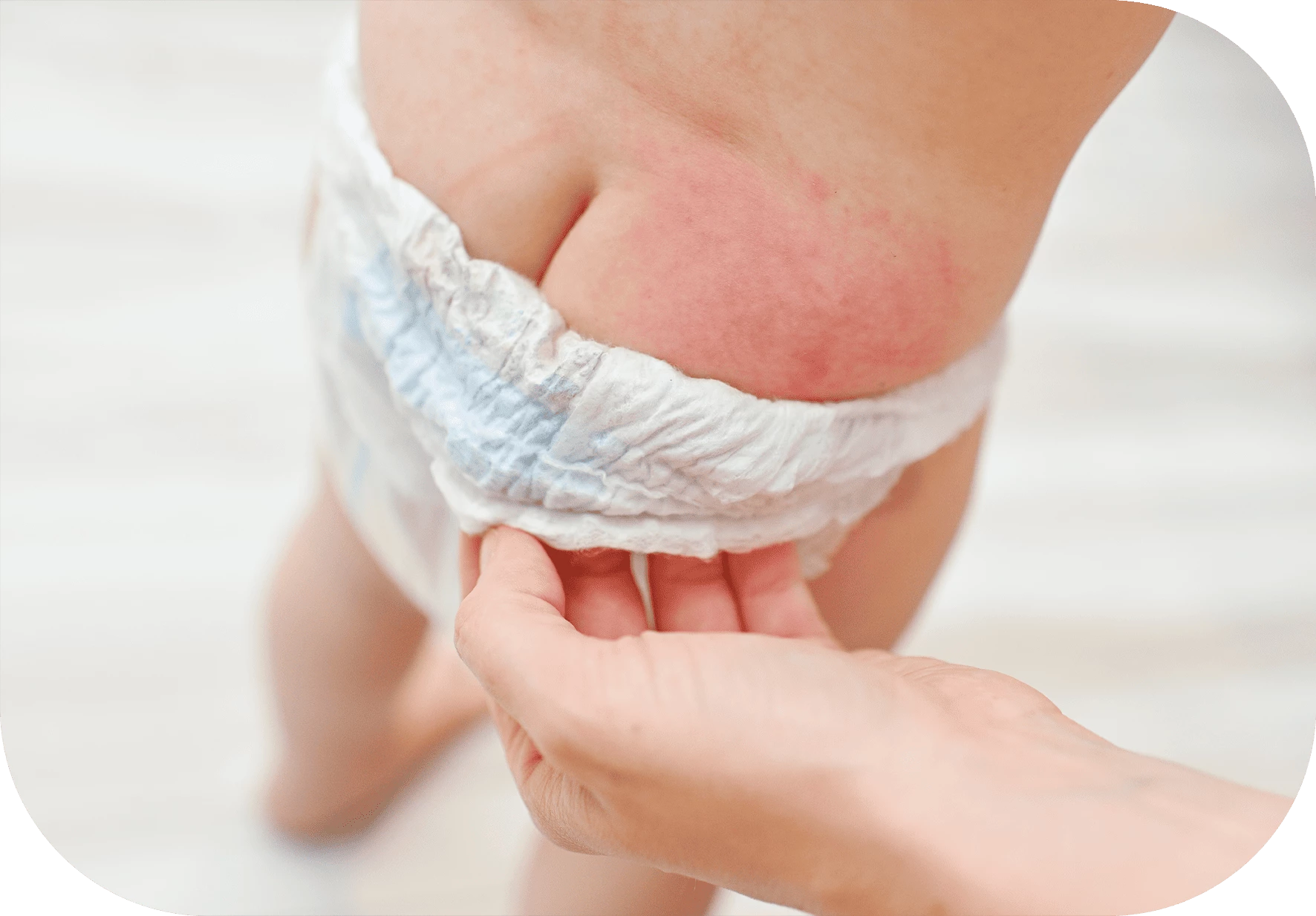 diarrea y dermatitis del pañal